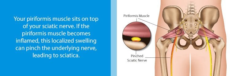 Sciatica Exercises: What's Best and What to Avoid - NJ's Top Orthopedic  Spine & Pain Management Center